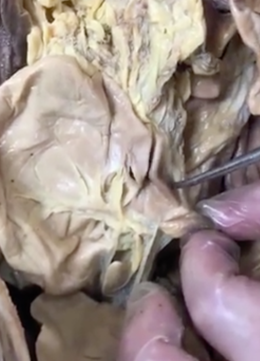 <p>what region of the stomach is prong pointing to (where it narrows)</p>