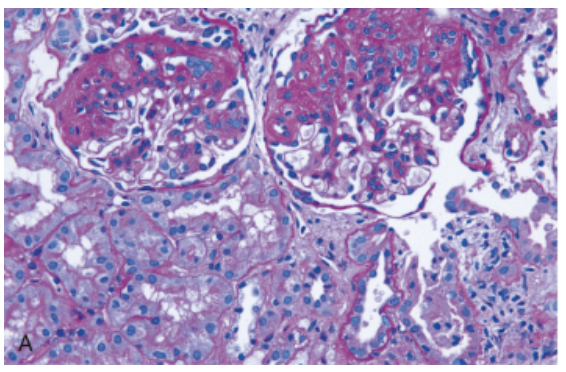 <p>A 38-year-old man presents with progressive lower extremity edema and frothy urine over 3 months. He has a history of poorly controlled HIV infection and past IV drug use. Blood pressure is 150/92 mmHg. Labs show serum creatinine 1.8 mg/dL and urine protein 6 g/day. Kidney biopsy (showed in the picture) shows segmental areas of sclerosis involving some glomeruli with collapse of capillary loops and hyalinosis. Which of the following options best matches the underlying pathogenesis of this condition?</p>