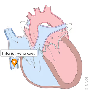 <p>Brings deoxygenated blood from the abdimen and legs into the heart</p>