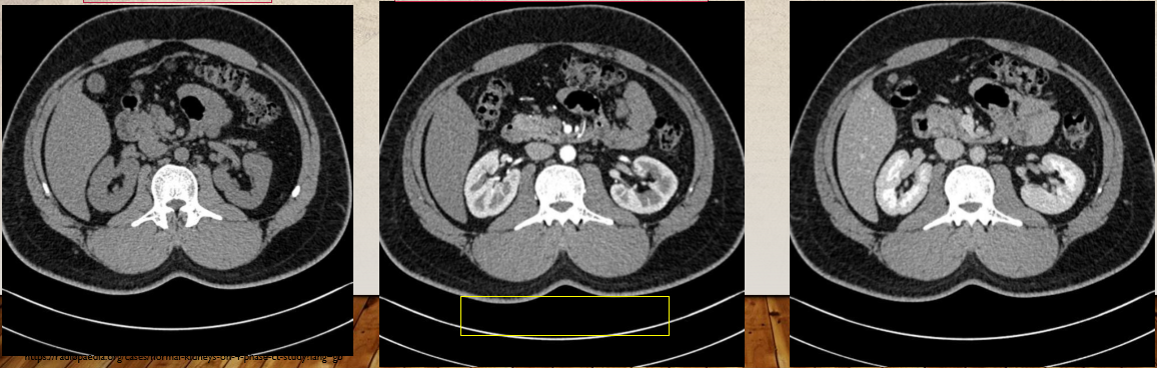 <p>What phases are these kidneys in </p>