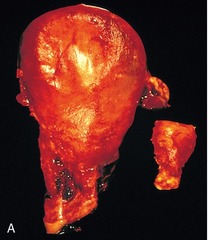<p>Smooth muscle in the main component of the uterine wall. Uterus on the left is during pregnancy and normal is on the right. Which is the best description of the enlargement of the left one?</p>