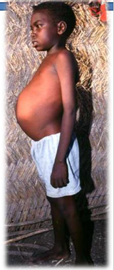 <p>Visceral leishmaniasis - symptoms</p>