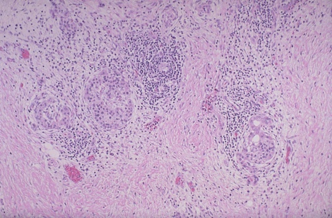 <p>pink fibrosis, remnants of islets</p>