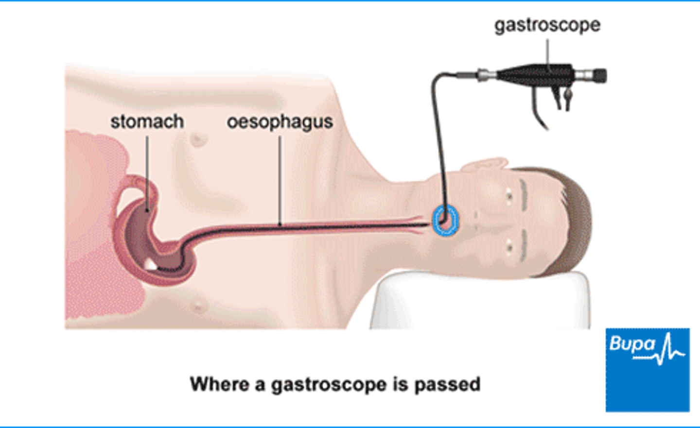 <p>gastroscopy</p>