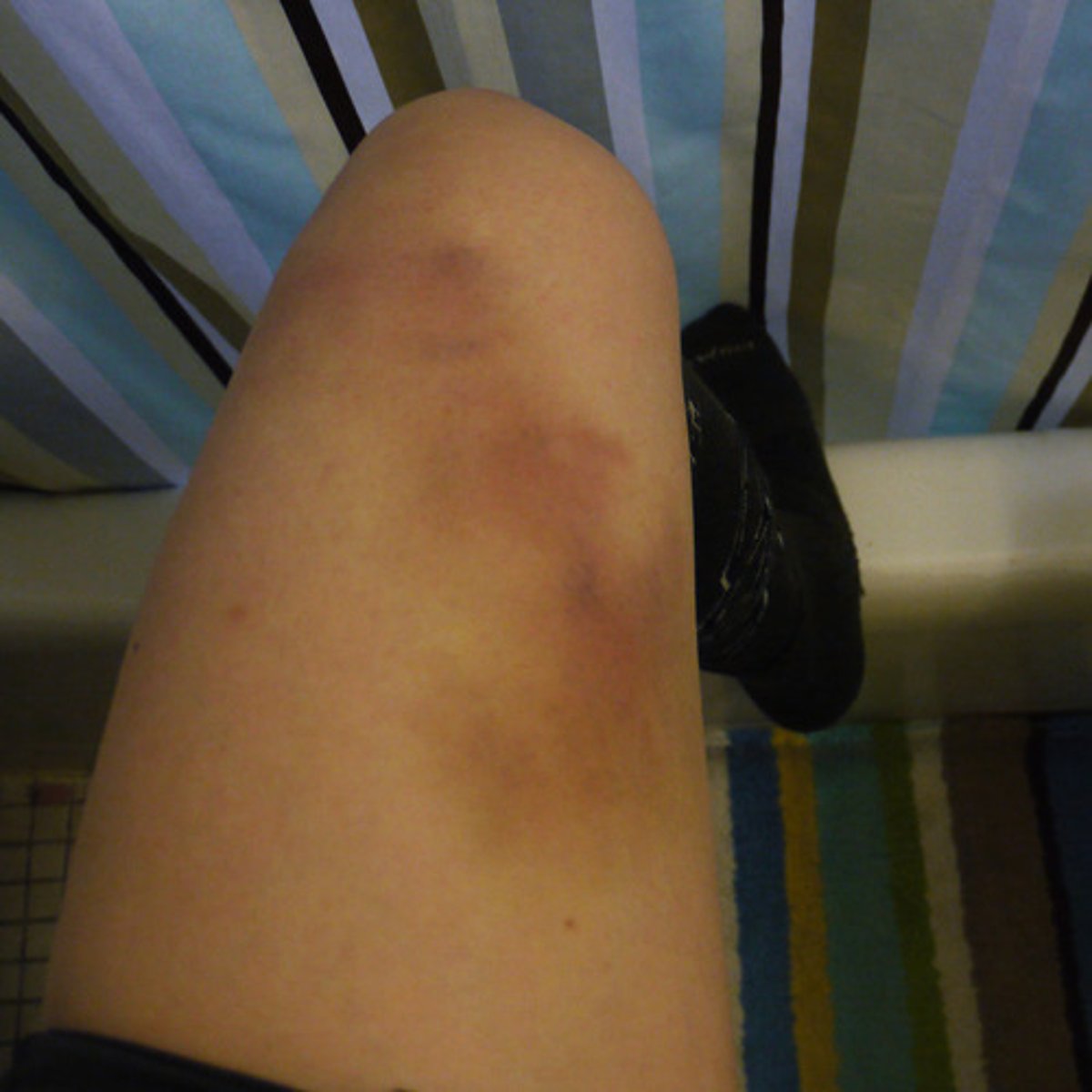 <p>bị bầm tím His arm was badly ___________ after the football match.</p>