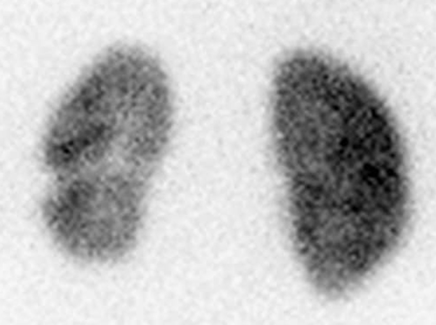 <p>asses for renal scarring in high-risk cases</p>