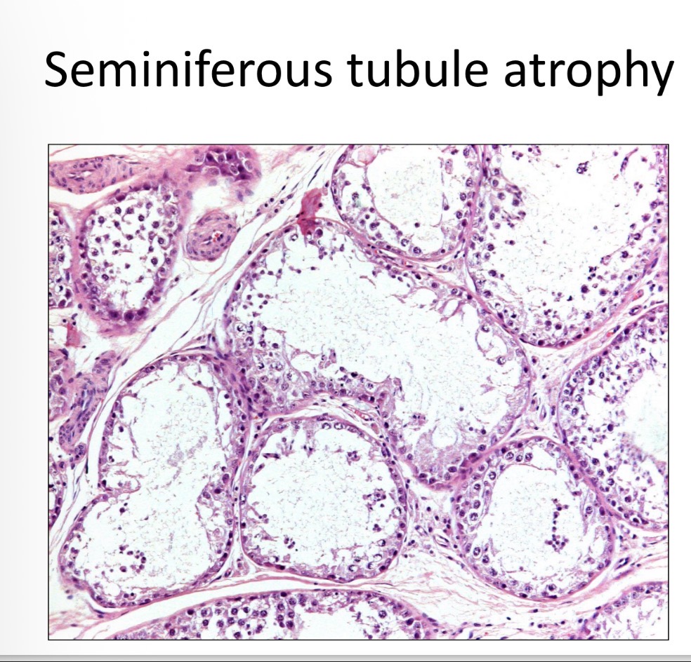 <p>feminisation </p><p>bilateral alopecia </p><p>cutaneous hyperpigmentation </p><p>opposite testis atrophy </p><p>pendulous prepuce </p><p>gynecomastia </p><p>M attraction </p><p>BM suppression </p><p>prostate sq epi metaplasia </p>