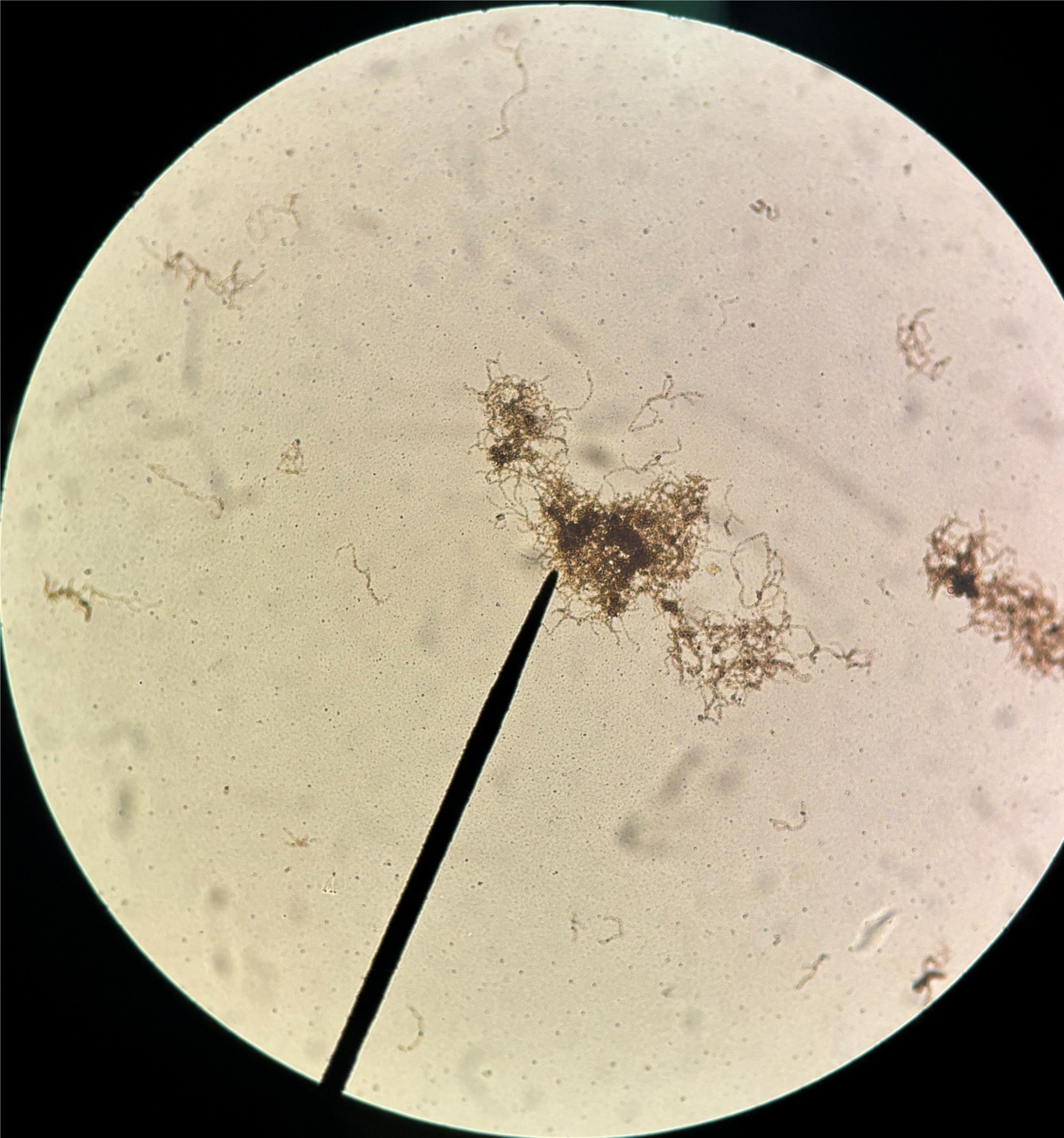 <p>What are the four stages and symptoms of this disease?</p>