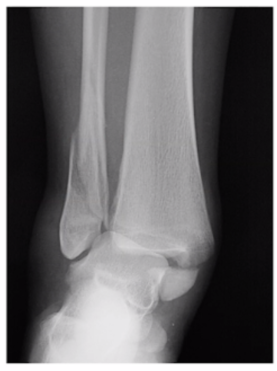 <p>What fracture is this?</p>