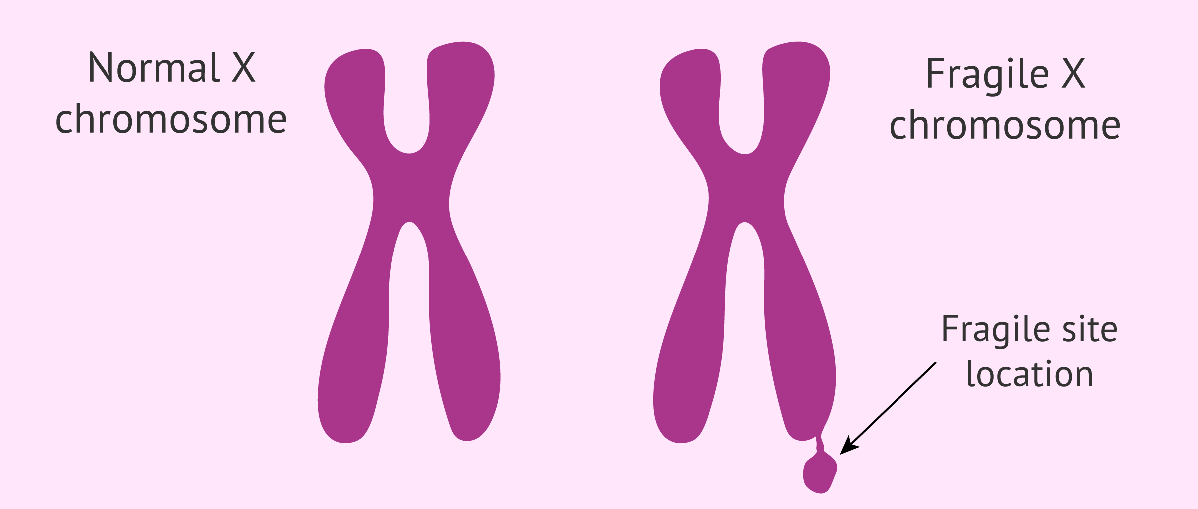 <p>Genetic disorder that occurs when a gene on the X chromosome is injured (simplified explanation from the slides, more accurate description is that a segment of the gene is duplicated so many times that it creates a fragile site that interferes with protein production)</p><ul><li><p>Results in mild to moderate intellectual disabilities</p></li></ul><p></p>