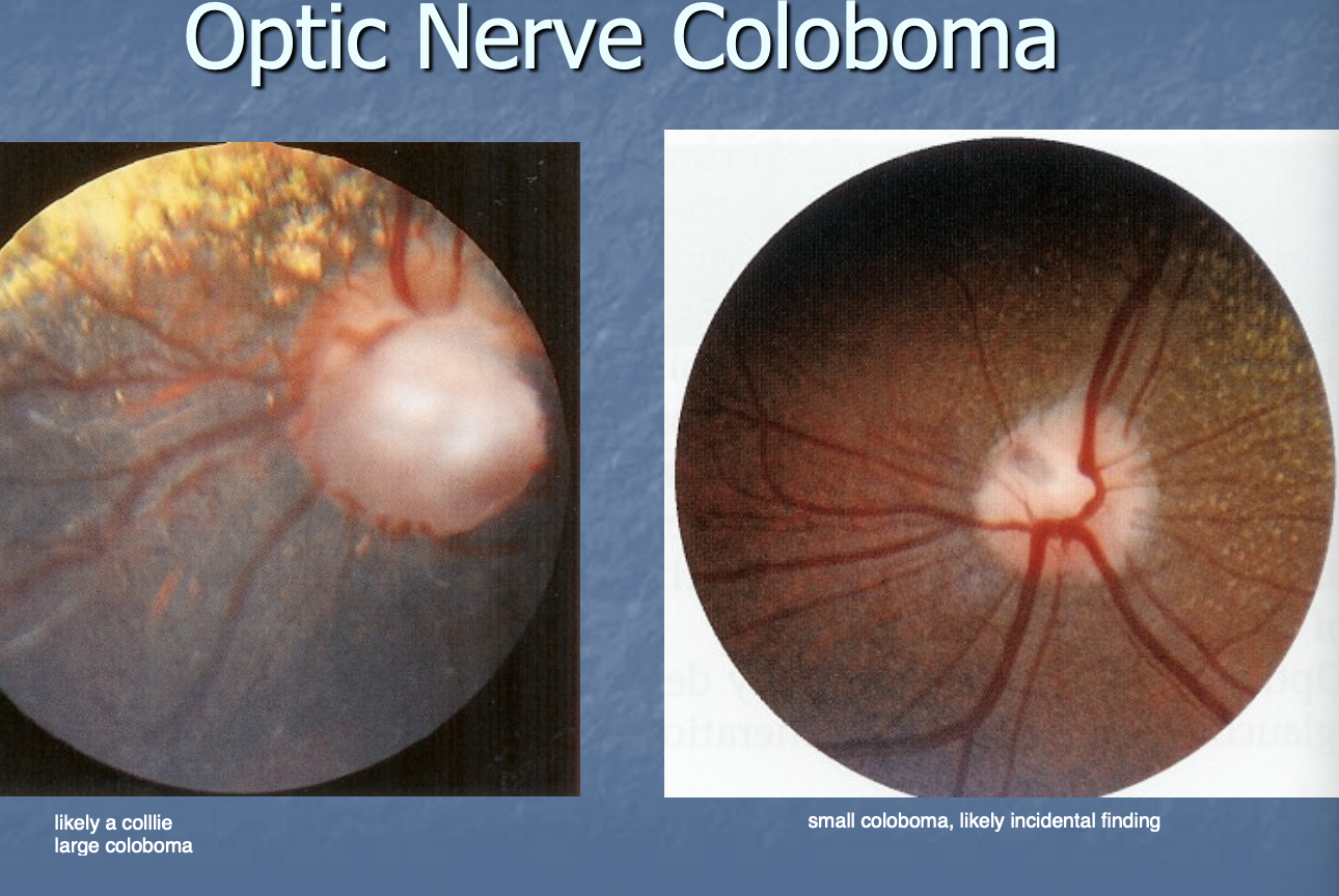 <p>congenital absence of optic disc, </p><p>usually presnets as gap, hole, figure, notch-shaped defect</p>
