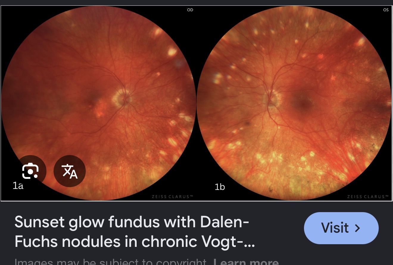 <p>Dalen fuchs nodules</p>