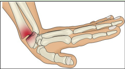 <p>Cause: FOOSH injury while wrist is extended</p><p>● A posterior/dorsal displacement fracture in the distal</p><p>radial segment towards the lister’s tubercle.</p><p>● Results in “Dinner fork” deformity</p>