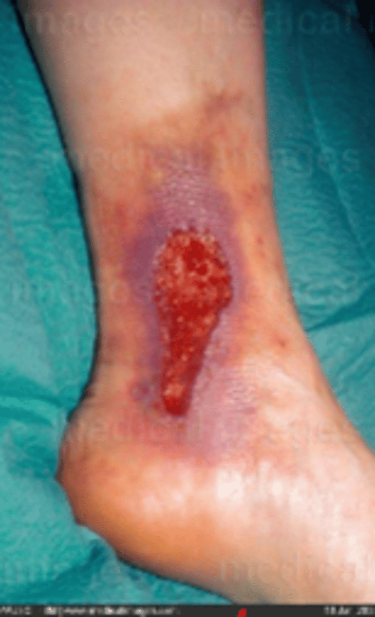 <p>causes: arteries become more elastic> blood pooling in LEs</p><p>Clinical presentations: edema, strong pulse (3+), hemosiderin deposition, spider veins, dull acheiness when on feets, irregular borders</p><p>treatment: compression, elevation, exercise in elevated position, dressing to absorb fluid</p>