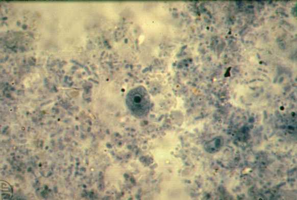 <p>5-12 um, <u>blunt hyaline pseudopods</u>, large irregular karyosome with no PC</p>
