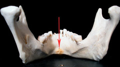 <p>Which part of the mandible is shown?</p>