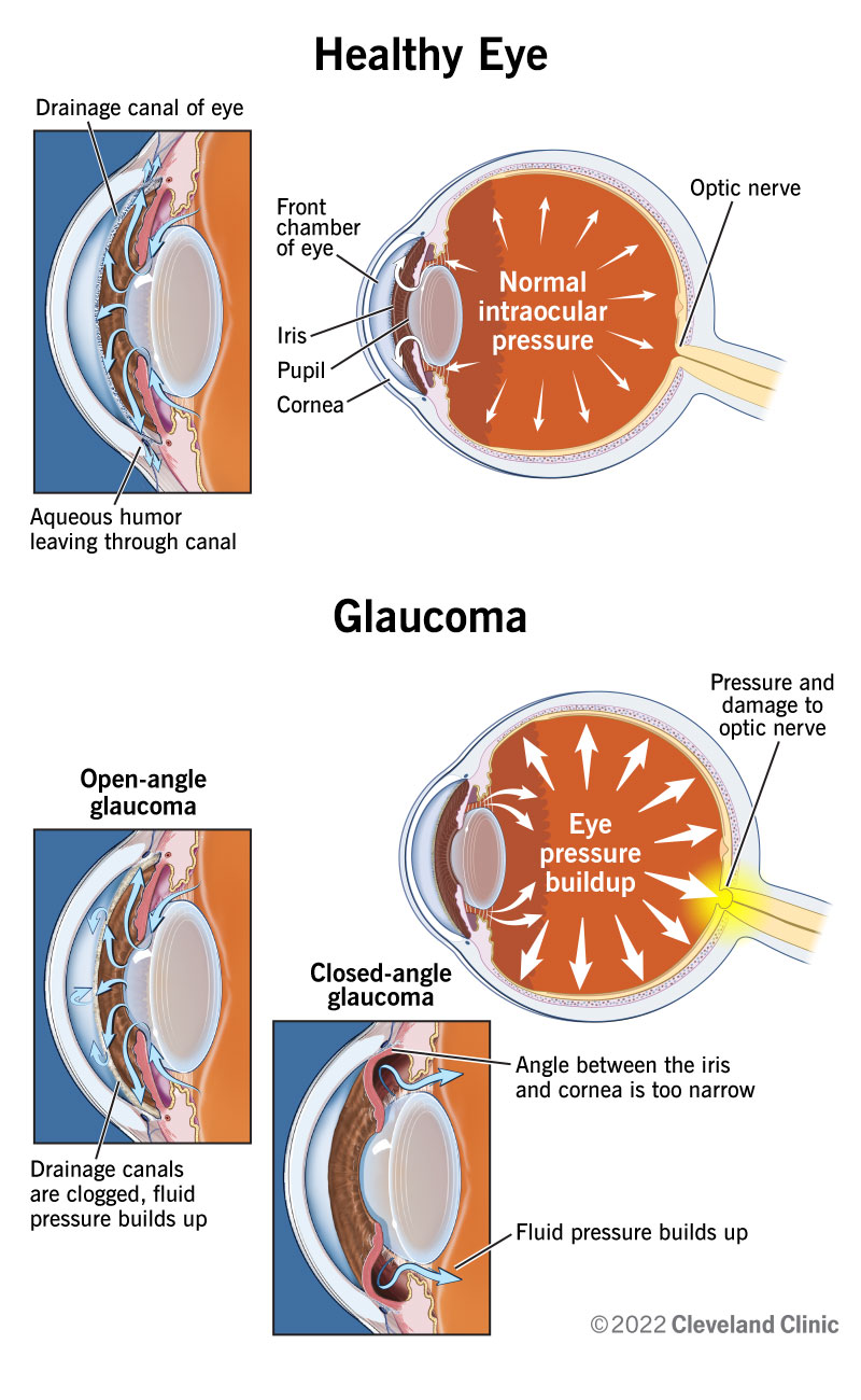<p>a group of eye disease characterized by an increased intraocular pressure </p>