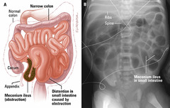 <p>Failure to pass meconium. Associated with CF w/ + prenatal screen or pt who never had screen.</p>