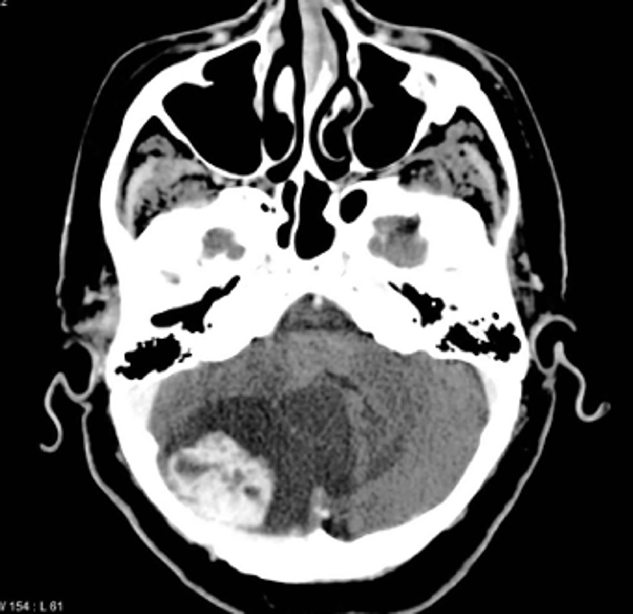 <p>MRI preferred to evaluate for smaller lesions and for solid components</p>