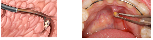 <p>sialolithiasis (salivary stone) treatment</p>