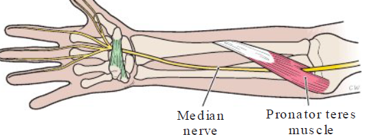 <p><strong>Definition</strong></p><ul><li><p>Painful disorder of wrist and hand — compression of median nerve between 2 heads of pronator teres muscle </p></li></ul><p></p><p><strong>Causes</strong></p><ul><li><p>Holding lower arm away from body</p></li></ul><p></p><p><strong>Symptoms</strong></p><ul><li><p>Similar to carpal tunnel syndrome </p></li></ul><p></p>