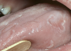 <p>etiology unknown; if symptomatic, burning sensation may be due to candida; 10% of psoriasis patients have it, more common in females (2:1) </p>