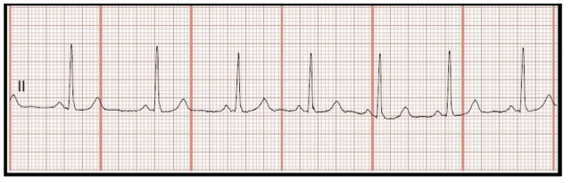 <p>Identify:<br>a. normal sinus rhythm<br>b. sinus bradycardia<br>c. 1st degree heart block<br>d. sinus arrhythmia </p>