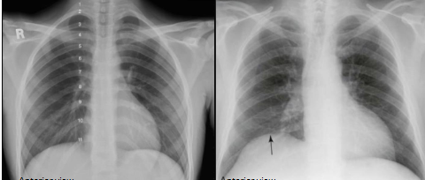 <p>Paradoxical breathing </p>