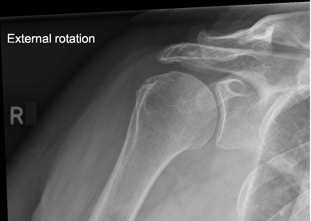 <p>correct rotation is evidenced by external rotation greater tubercle in profile laterally, angle of the tube opens up the sub acromial space </p>