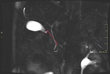 <p>Low insertion av cystic duct. Surgery needs to take extra care not to ligate common bile duct (choledochus / CBD)</p><p></p>