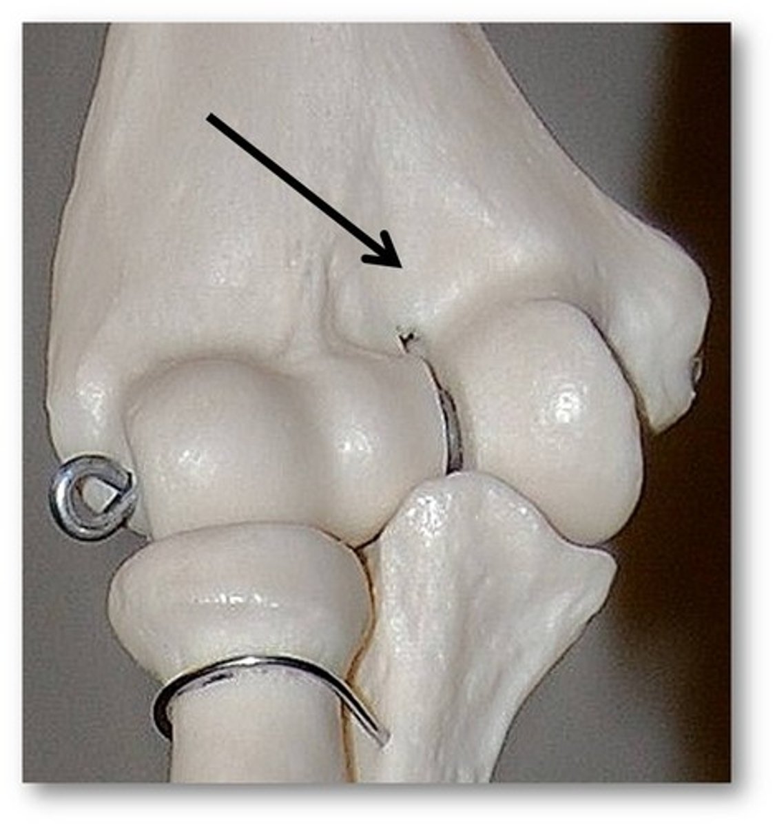 <p>- Anterior depression that receives the coronoid process of the ulna during forearm flexion</p>
