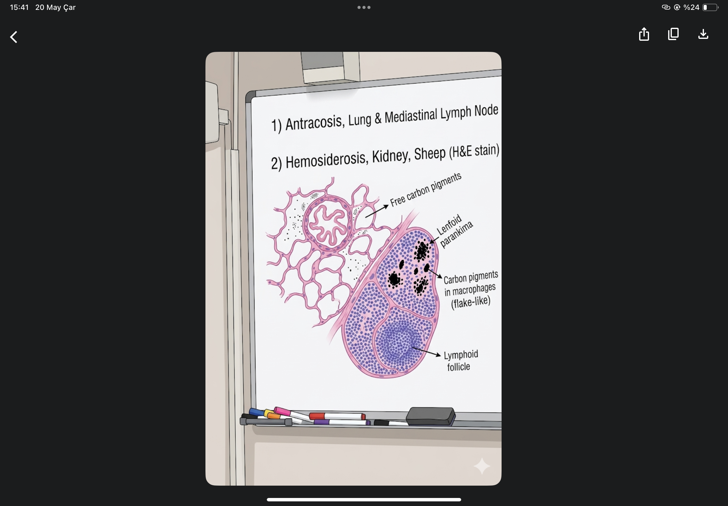 <p>antracosis, lung and mediastinal lymph node</p>