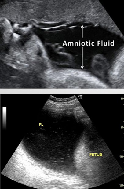 <ul><li><p>generally echo-free</p></li><li><p>can sometimes see tiny echogenic particles</p><ul><li><p>blood, normal variant, vernix caseosa, meconium</p></li></ul></li><li><p>presence of a dense collection, or sludge, could indicate infection</p></li></ul><p></p>