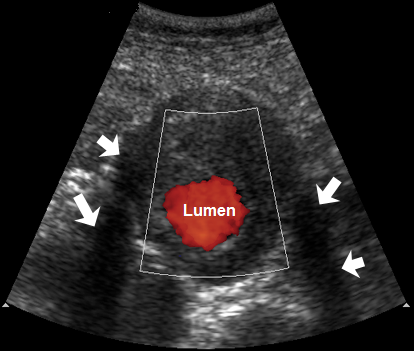 <p>Assessment of the total outer diameter of the blood vessel is needed because that determines the risk of rupture</p>