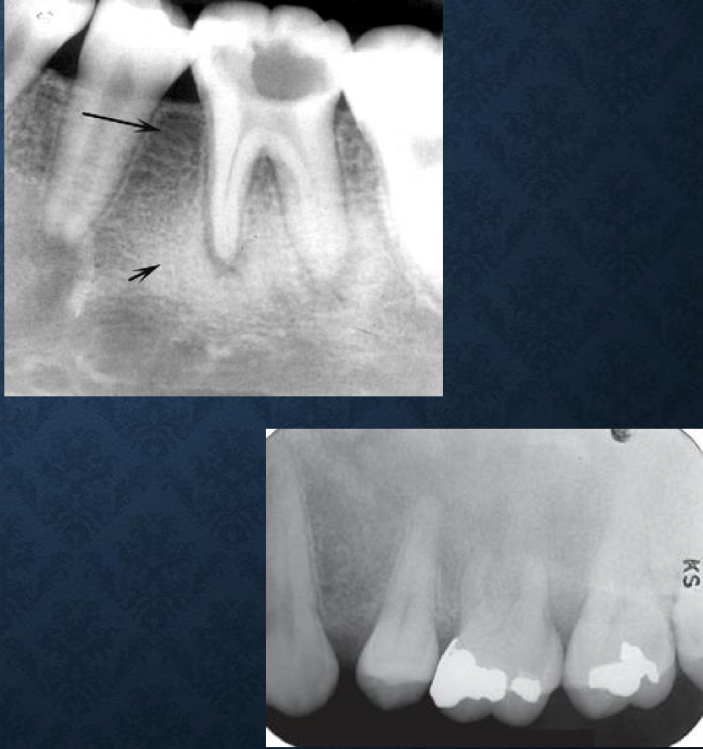 <p>gradual transition between adjacent normal and abnormal bone</p><p>focus on trabecular, not marrow</p>