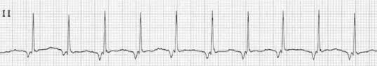 <p>Accelerated Junctional Rhythm</p>
