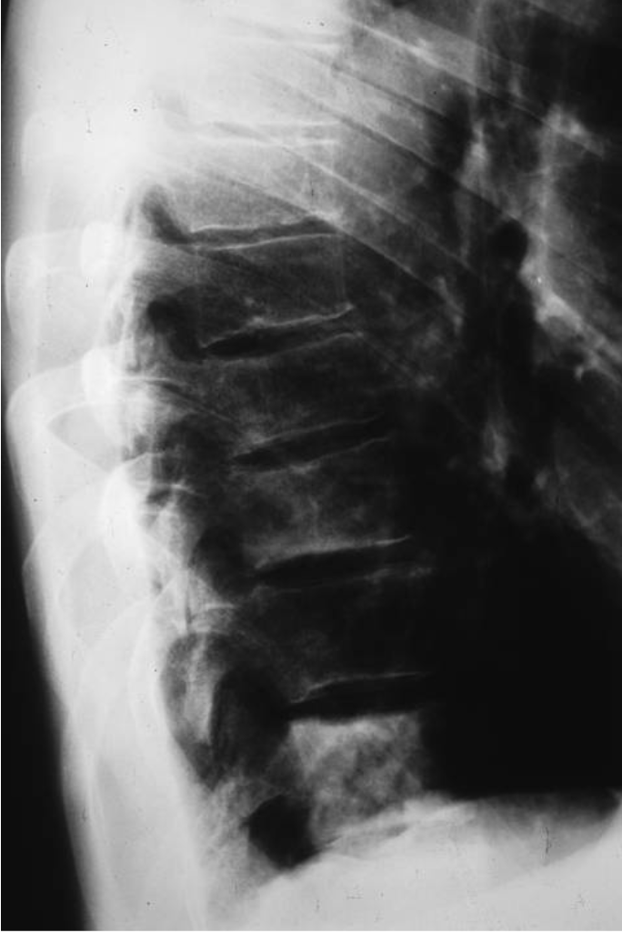 <p>What tumour like disorder is this, where is it, what can be seen?</p>