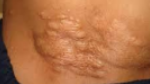 <p>connective tissue hamartomas occurring in 20% of tuberous sclerosis patients typically in the lumbosacral region.</p>