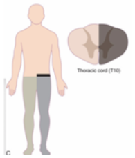 <p><span style="background-color: transparent;"><span>-Damage to one side of the spinal cord (stabs, GSW)</span></span></p><p></p><p><span style="background-color: transparent;"><span>-Ipsilateral: Proprio, vibration, weakness&nbsp;</span></span></p><p><span style="background-color: transparent;"><span>-Contralaterally: Pain/Temp are lost</span></span></p><p><br></p>