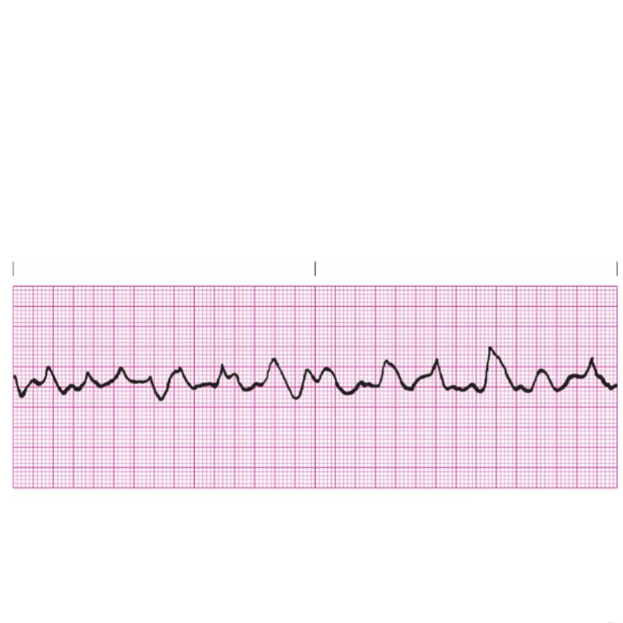 <p>Rules for Ventricular Fibrillation</p>