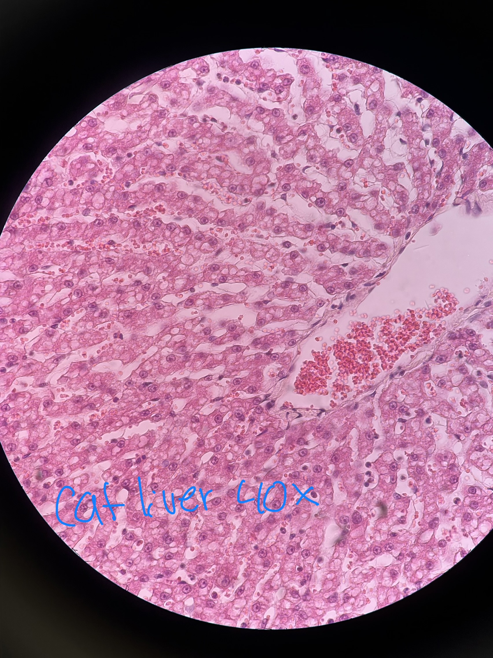 <p>What cell inclusion is in this sample and why does it indicate?</p>