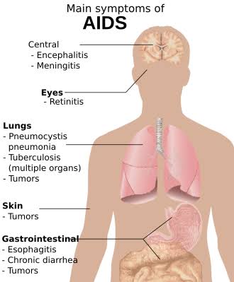 <p>AIDS</p>