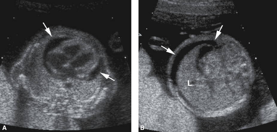 <p>Anechoic fluid surrounding the heart</p>