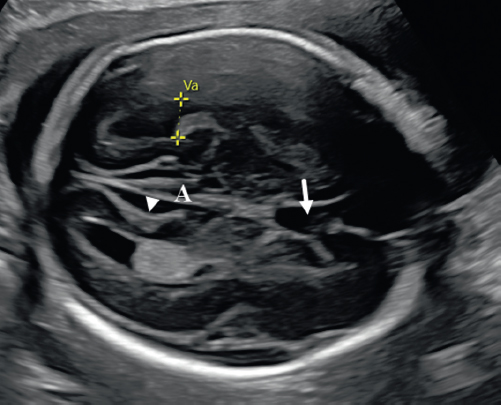 <p>15. What does the arrow in Figure 24-39 indicate?</p><p>Figure 24-39</p><p>a. Third ventricle</p><p>b. Fourth ventricle</p><p>c. CSP</p><p>d. Cerebral aqueduct</p>