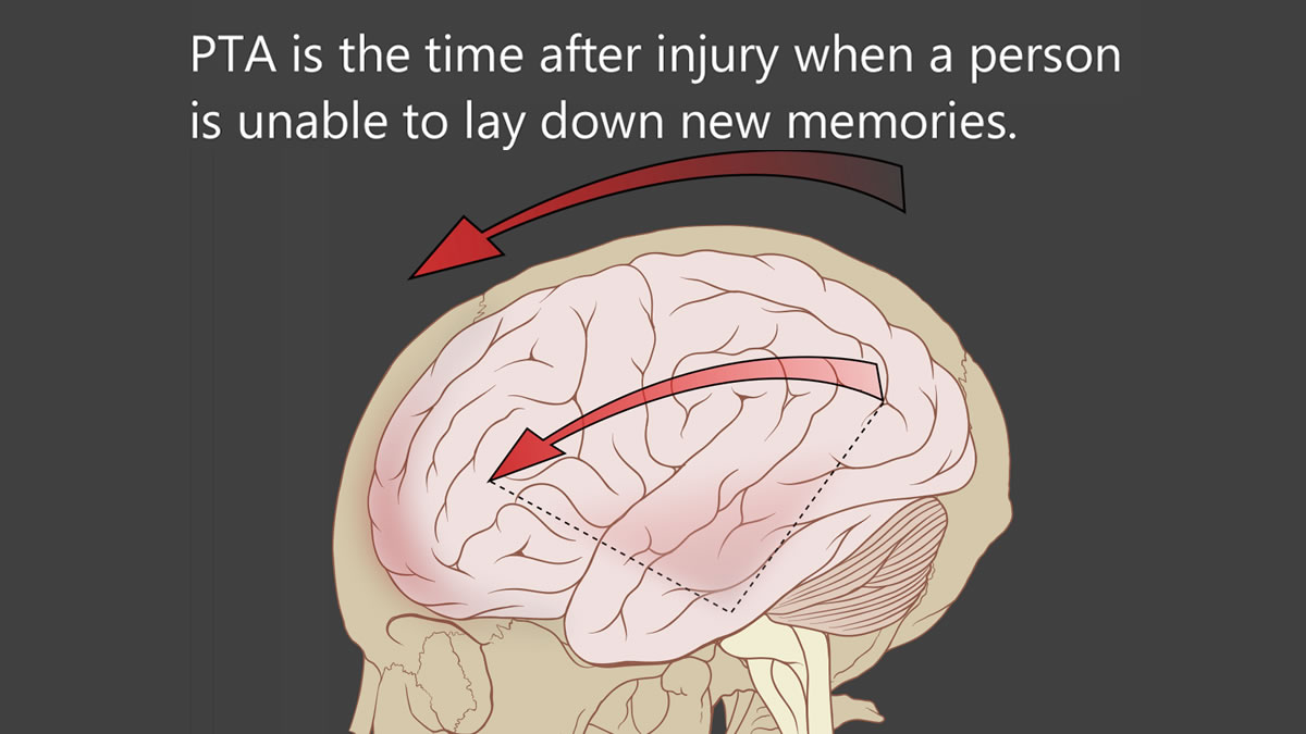 <p>Memory <strong>disruption </strong>following a <u><mark data-color="#d4dff2" style="background-color: rgb(212, 223, 242); color: inherit;">head injury or concussion.</mark></u></p>