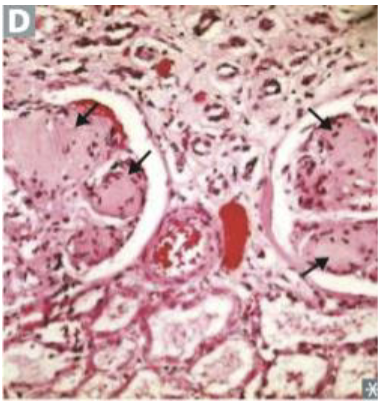 <p>This change of the glomerulus is associated with which condition?</p>