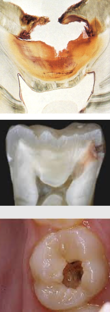 <ul><li><p>The caries has progressed<strong> through the dentin and approaches the pulp</strong></p></li><li><p><strong>“Trap on the occlusal surface”</strong>: The destruction underneath can be much larger than what is visible from the occlusal surface - the surface opening may look relatively small while caries has spread extensively through the underlying dentin.</p></li><li><p>The remaining tooth structure may become<strong> undermined and weakened</strong>.</p></li><li><p><strong>Spontaneous pain</strong>: Pain that occurs even without an obvious external stimulus.</p></li><li><p><strong>Urgent treatment is needed</strong>: The lesion is getting close to the pulp!</p></li></ul><p></p>