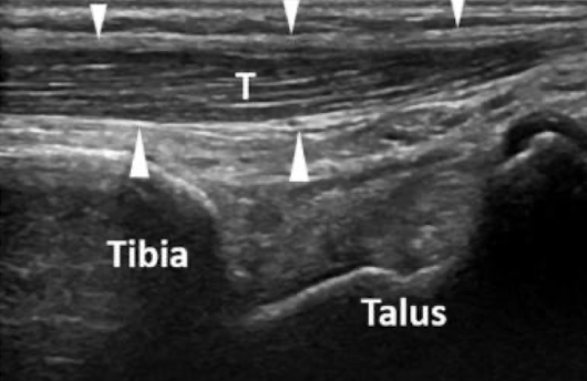 <ul><li><p>bundles of connective tissue that attach <span style="color: yellow;">muscle to bone</span></p></li><li><p>proximal attachment is called the <strong><em>origin</em></strong>, and distal attachment is the <strong><em>insertion</em></strong></p></li><li><p>portion of the attachment to the muscle is called the <strong><em>musculotendinous junction</em></strong></p></li><li><p>point of attachment to the bone is the <strong><em>osteotendinous junction</em></strong></p></li><li><p>SONO: hypo-hyperechoic fibillary appearance; surrounded by thin, echogenic peritoneum</p></li></ul><p></p>