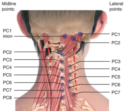 <p>PC3-PC8 tender point treatment?</p>