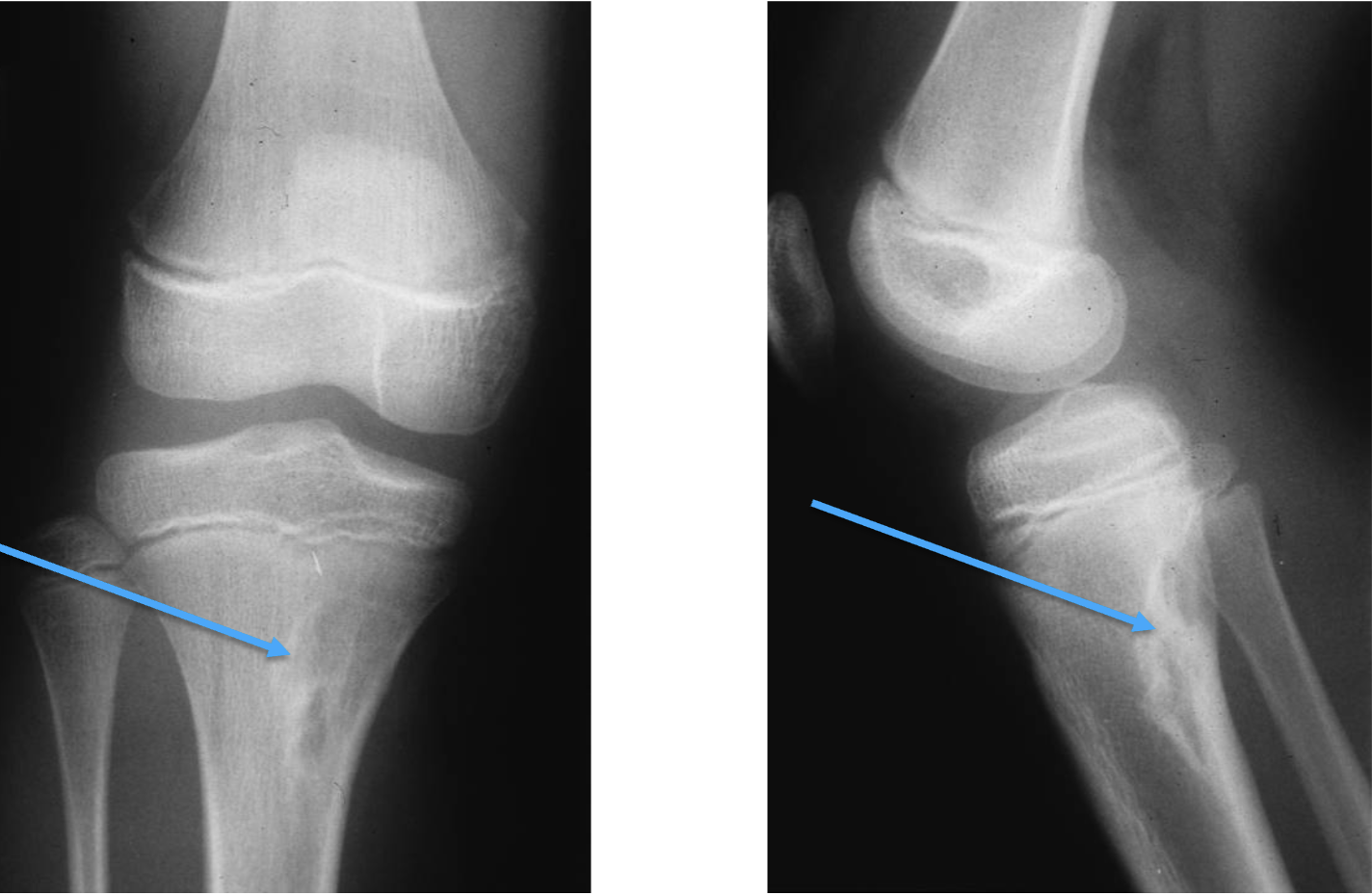 <p>What bone tumour is this, what bone is it in and what can be seen?</p>
